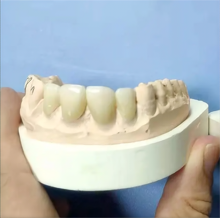 zirconia dental